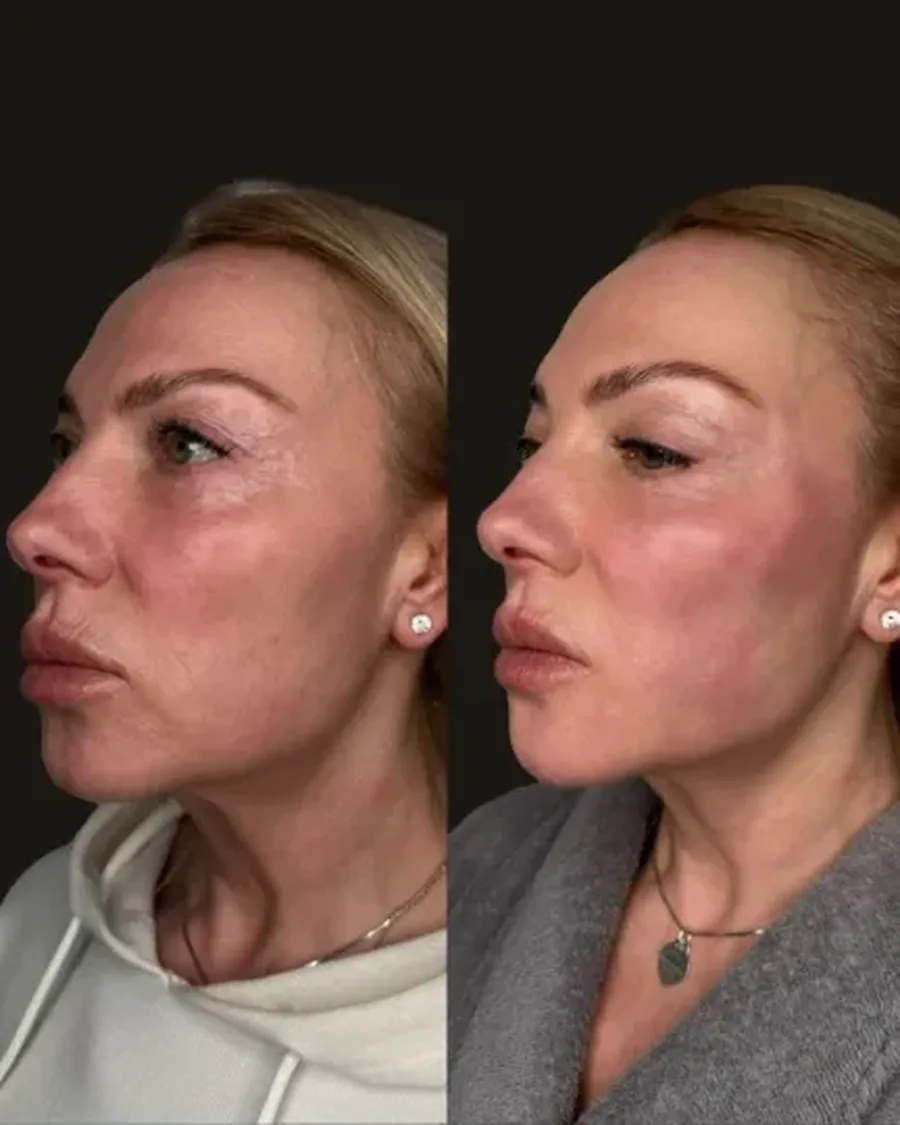 Before and after facial rejuvenation result at American Aesthetic Medical Center